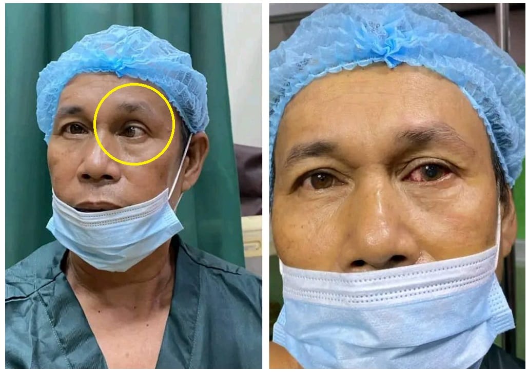 ALAMIN: Mga duling inopera ng libre, hindi na duling